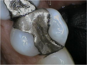 Image of a silver filling by Boulder Dental Arts