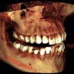 With CBCT we can get a 3D image of your teeth
