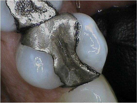 The Silver Filling