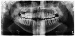 An example of a mouth crowded by pesky wisdom teeth.