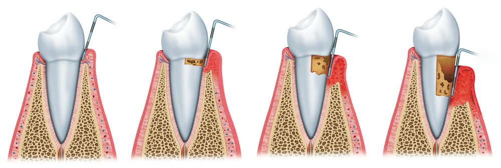 Dental Cleanings