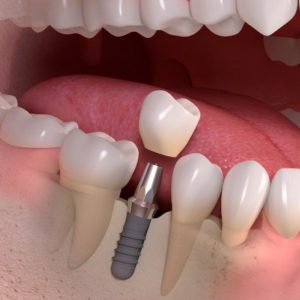 Dental Implants