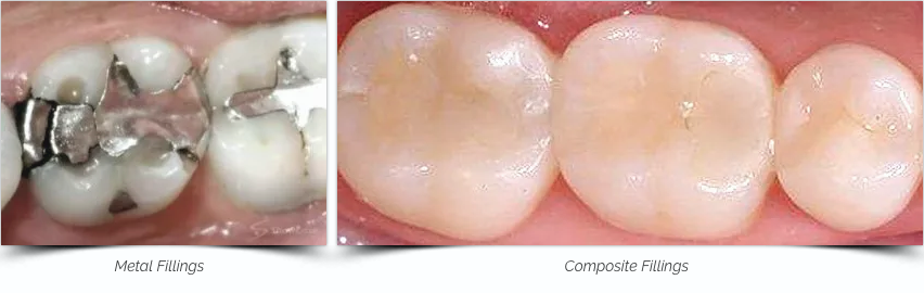 Dental Fillings, metal vs composite fillings